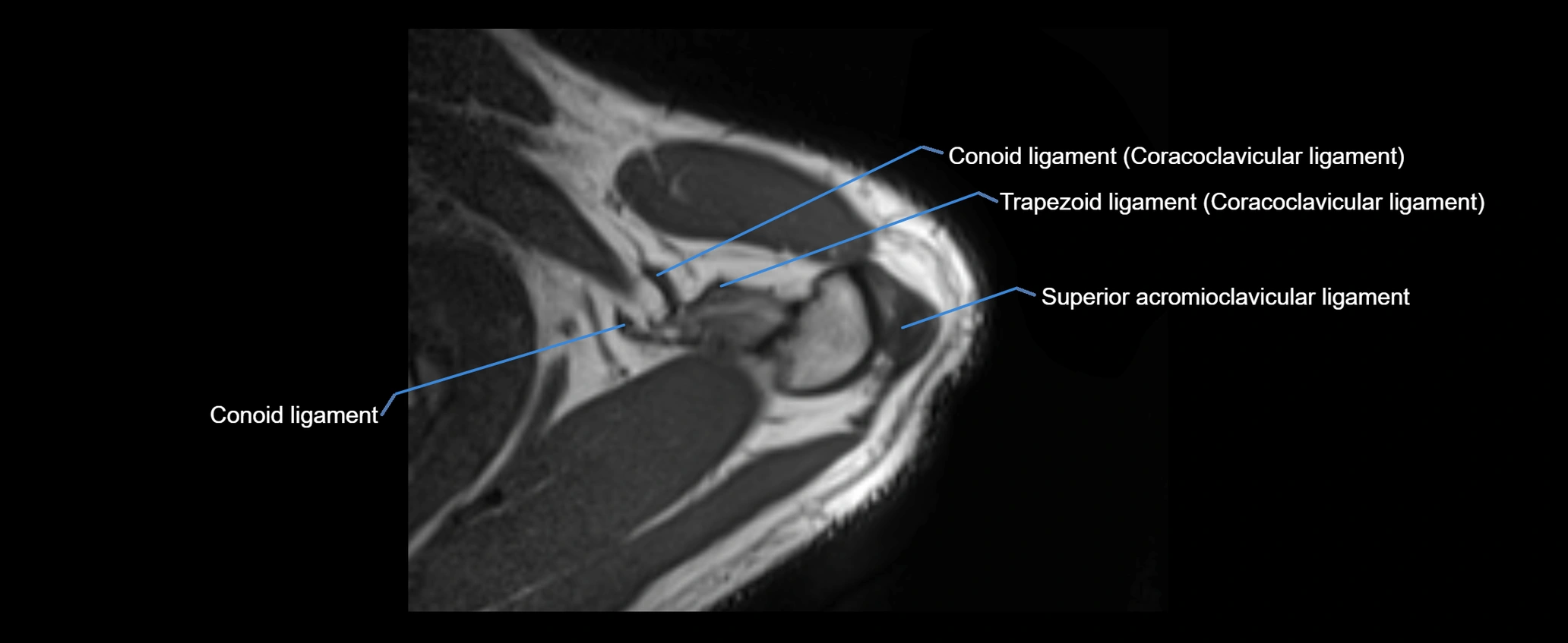 shoulder ligaments axial 3d 3t mri image-img-00005-00024.webp